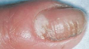 How to recognize fungus on toenails How to recognize foot fungus
