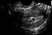 Wie lange zeigt ein Ultraschall eine Schwangerschaft an und wo kann die erste Studie durchgeführt werden, um sie im Frühstadium zu bestätigen?