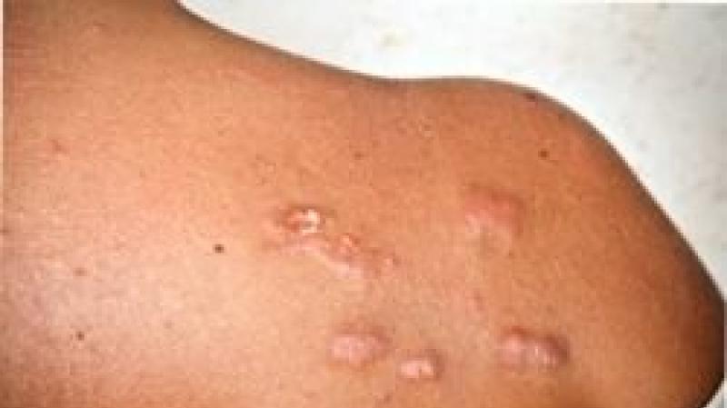 Keloid scars: causes and treatment