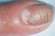 How to recognize fungus on toenails How to recognize foot fungus