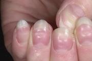 Flowering nails.  Why do nails “bloom”?  Why do children's fingernails bloom?
