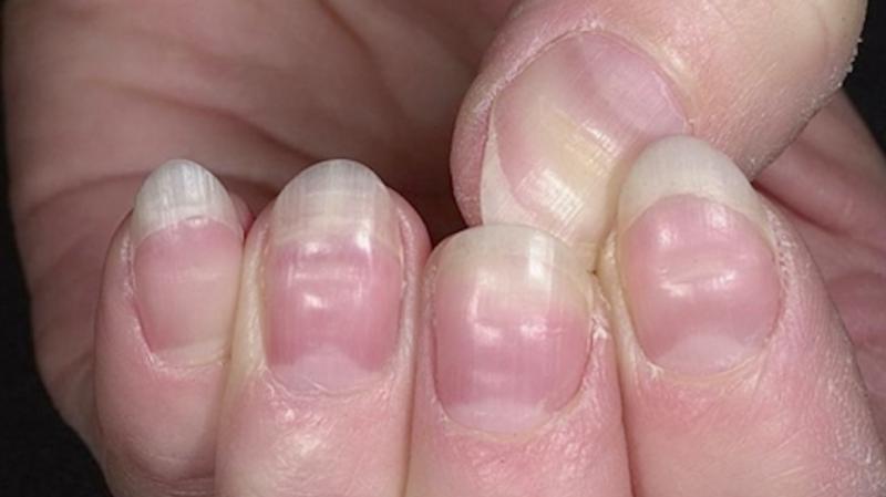 Flowering nails.  Why do nails “bloom”?  Why do children's fingernails bloom?