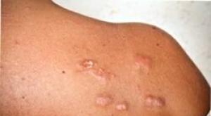 Cicatrici cheloidi: cause e trattamento